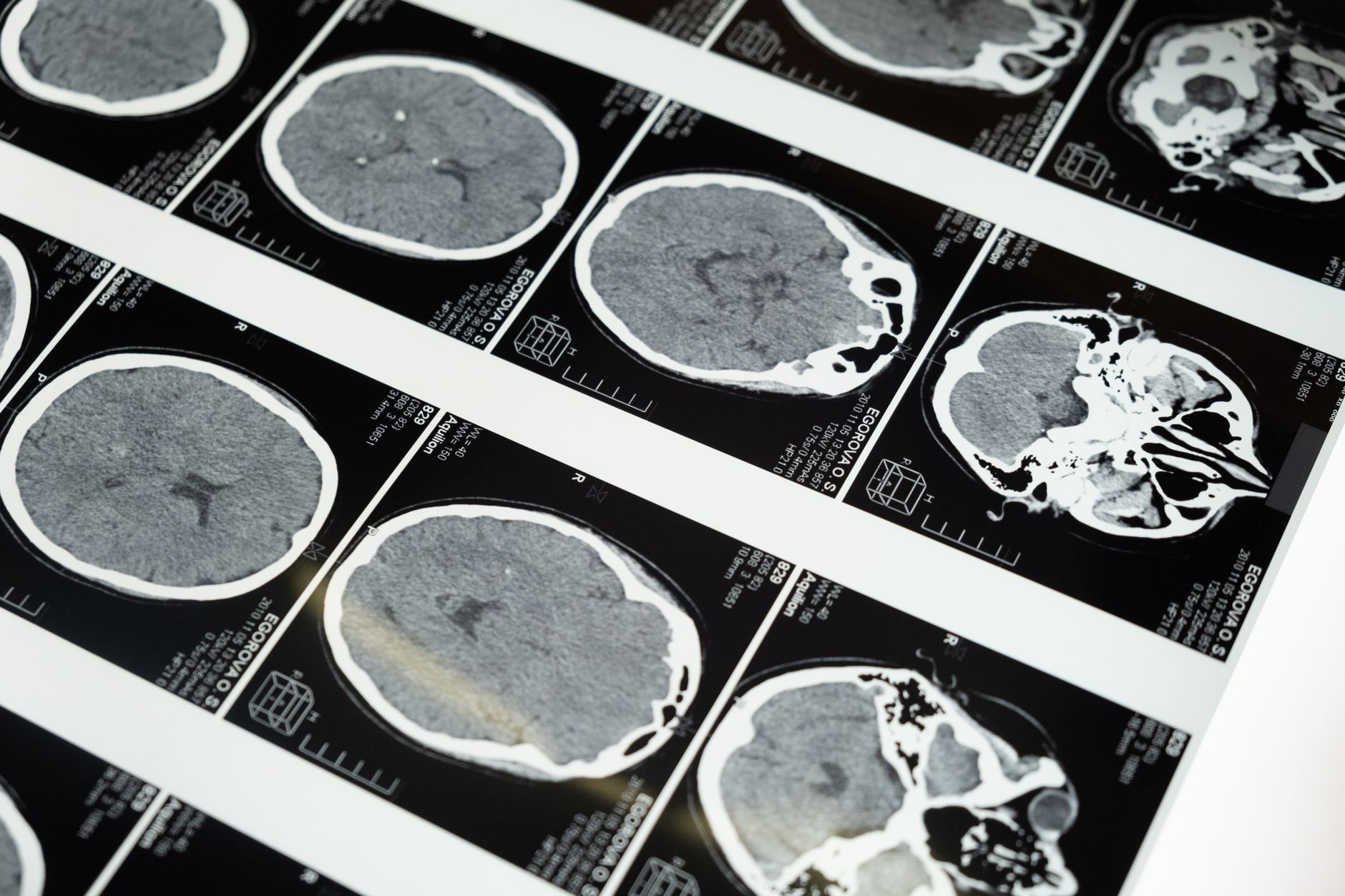 Uma imagem mostrando uma interface de inteligência artificial com gráficos e dados médicos sobrepostos a uma imagem de cérebro, simbolizando a transparência no diagnóstico.